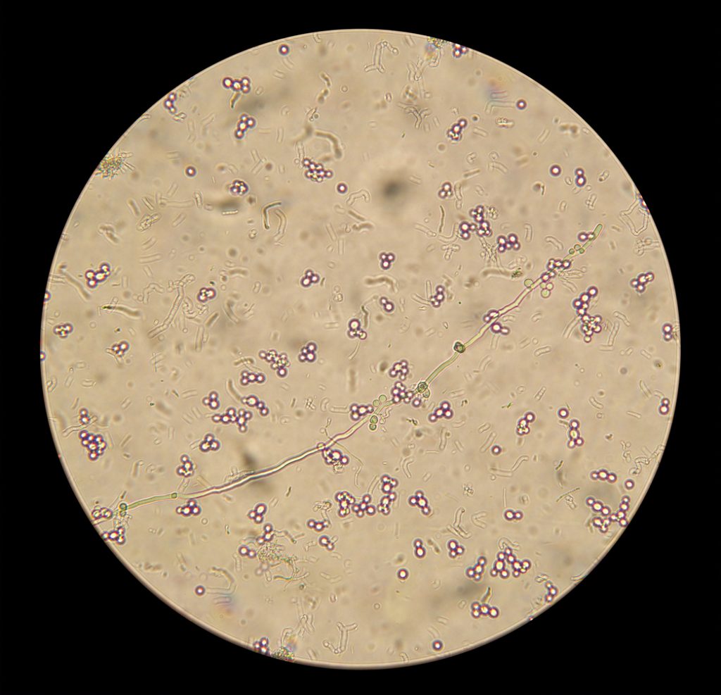candidiasis en el embarazo