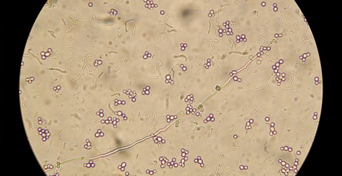 candidiasis en el embarazo