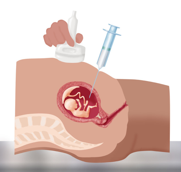 prueba de la amniocentesis